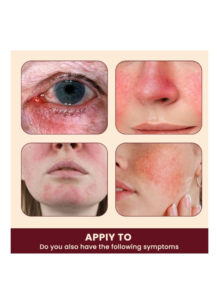 Sumifun Rosacea Treatment Face Cream Red Nose Redness Relief Acne Cream 30g - Image 2