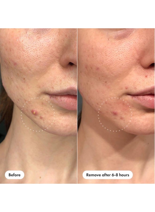 Mighty Patch ™ Invisible+ Patch – The Barely-There Daytime Hydrocolloid Acne Pimple Patch for Covering Zits and Blemishes, Tapered Edges Designed to Blend Into Skin (72ct) - Image 3