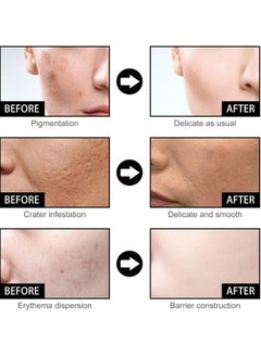 EELHOE Niacinamide Facial Essence, 50ml Whitening Pimple Treatment Hyaluronic Acid Serum, Anti Wrinkle And Anti Aging Face Serum For Pimple, Acne And Pore Shrinking  - Image 4