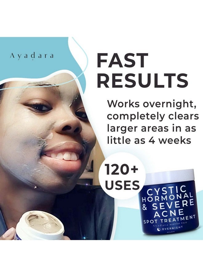 AYADARA Cystic Acne Spot Treatment 120+ Treatments Overnight Cystic Acne Treatment For Hormonal And Severe Acne Overnight Results On Stubborn Acne Spots & Blemishes  - Image 4