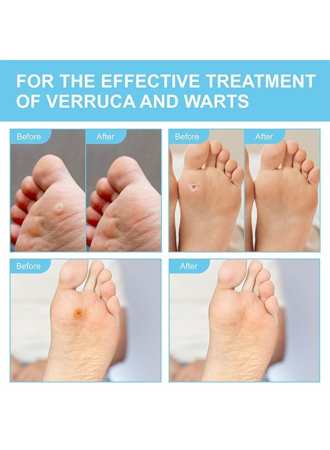 إليمي 24 قطعة من وسادات مزيل الثآليل ، جص الذرة الثآليل القوية لإزالة الثآليل على القدمين وأصابع القدم واليدين ، تصميم ذاتي اللصق نتائج سريعة مريحة ، العناية بالقدم - Image 5