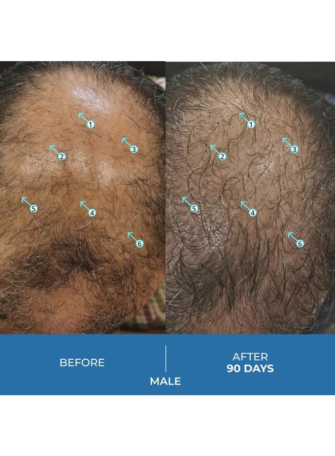 DS LABORATORIES DS Labs Spectral.UHP 5% Minoxidil Hair Density Serum - Extra Strength Topical Formula for Thicker-Looking Hair, Targets Thinning at the Crown Area, With Nanosome Technology, 60mL - Image 3