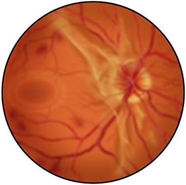 ملصق طباعة الشبكية مع اعتلال الشبكية السكري المتقدم من TriFocal CommunicationsStocktrek Images (11 x 17)