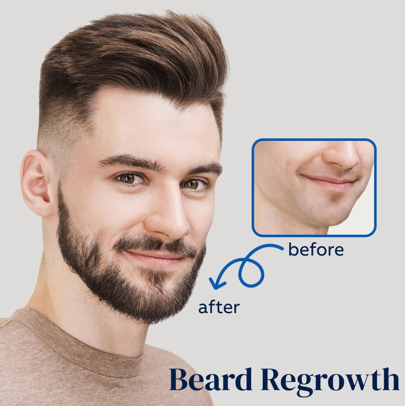 FUZYAT 5% Minoxidil Spray for Men and Women, Minoxidil for Women Hair Growth, Minoxidil for Men Hair Growth Spray 4PCS. - Image 3