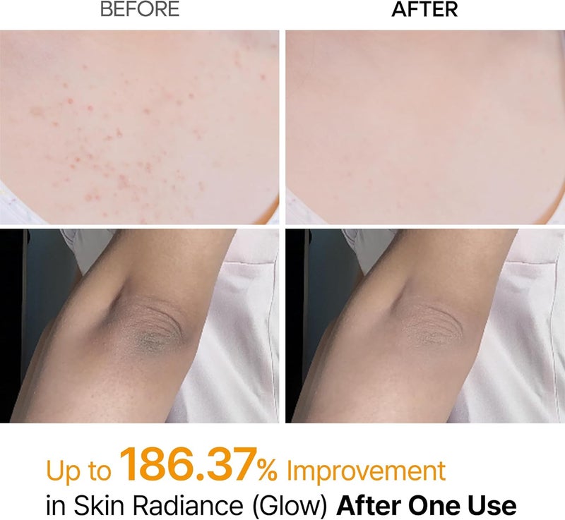 Global trendy simple build Body Keratin Care Kojic Acid Turmeric Spray Gently Exfoliating Peeling Solution Korean Skincare All Skin Types 200ml Transit damage minimized design - Image 3