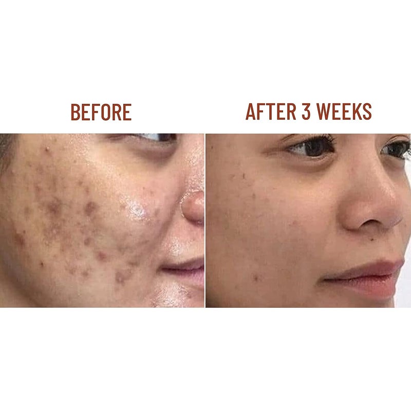 ABERA Nano Turmeric Vitamin C Serum Nourish and Brighten Skin Tone Reduce Dark Spots Acne Bruise Relief Restore Skin Strength Skin Care Oil for Face 051 Fl Oz Set 2 - Image 3