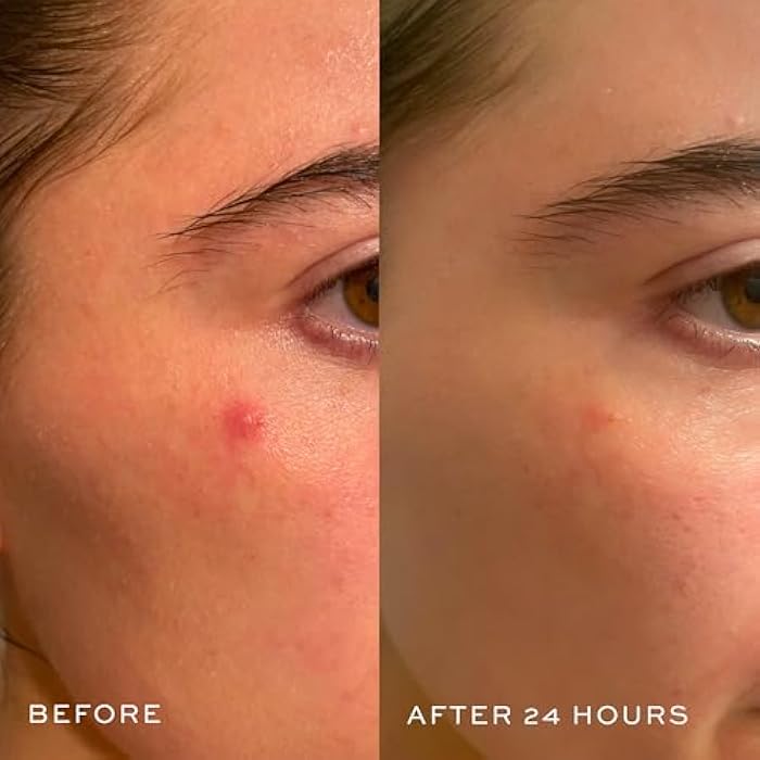 DIME Beauty Power Patch, 72 Count - Hydrocolloid Pimple Patches, Zit Spot and Blemish Aid with Salicylic Acid, Vitamin A, and Clove Oil - Image 5