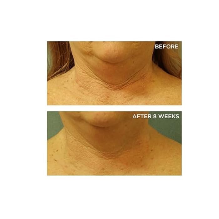 Perricone MD Cold Plasma Plus+ Neck & Chest Broad Spectrum Moisturizer - Image 4