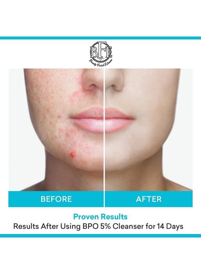 بيوتي فيشال إكستريم علاج حب الشباب بغسول الوجه مع بنزويل بيروكسيد ٥٪ - تخلص من بقع حب الشباب عند التلامس مع البثور الكيسية، والبشرة الدهنية، والمسام المسدودة، والرؤوس السوداء والبيضاء، والبثور. احصل على بشرة صافية. - Image 3