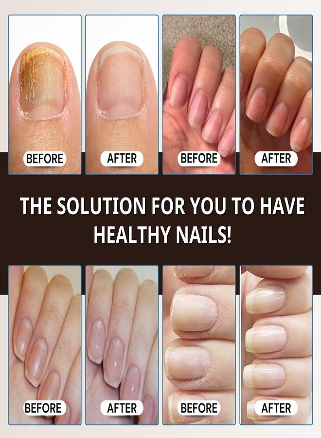 Abera Combo Premium Nail Restoration Drops - Nourishing Support for Weak, Stained & Deformed Nails - Supports Healthy Nails with Quick-Drying Formula for Fingernails and Toenails - Image 3
