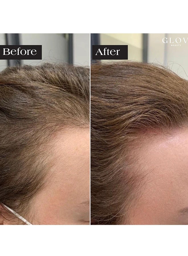GLOV Microneedle Infusion Hairregrowth Solution, Alphainfuse Hair Regrowth System, Painless Microneedle Infusion Hairregrowth Solution, Scalp Nourishing Oil, Damage Repair, Loss Prevention, Enhances Thick Hair For Men Women #2+6 - Image 5