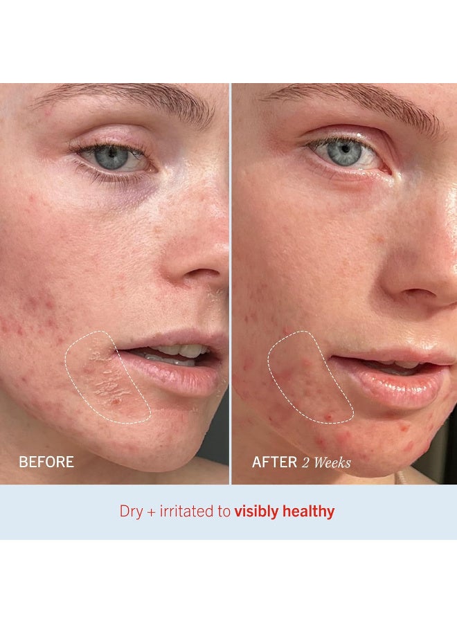 First Aid Beauty First Aid Beauty - Ultra Repair Cream, Intense Hydration Whipped Colloidal Oatmeal, Clinically Proven to Strengthen Skin Barrier in 7 Days & Helps Relieve Eczema, Luxury Face & Body Moisturizer, 6 oz - Image 5