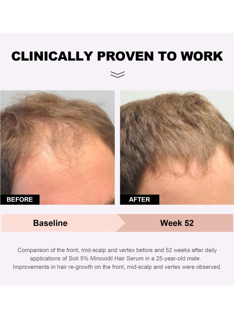 سوتي مصل Soti مينوكسيديل 5% لنمو الشعر، مصل إعادة نمو الشعر لحالات تساقط الشعر 60 مل. صنع في الولايات المتحدة الأمريكية! ينصح به أطباء الأمراض الجلدية. تركيبة الجنسنغ والبيوتين فائقة القوة (6 عبوات) - Image 2