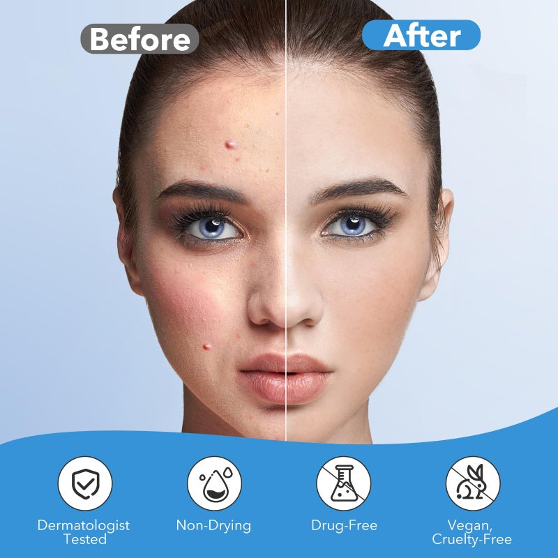 QUSTERE Pimple Patches for Face, Acne Patches Hydrocolloid, Cute Star Zit Covers for Face, Spot Stickers with Tea Tree, Salicylic Acid & Cica Oil| Round,Star,Peach Shapes| 5 Sizes| 282 Count - Image 4