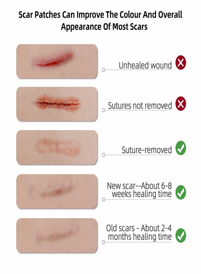 TIERSINI Silicone Scar Sheet, Silicone Scar Tape for Surgery (1.6” x120” Roll-300CM), Silicone Scar Strips, Keloid Treatment, C-Sections, Surgical Scars, C-Section Scars - Image 4