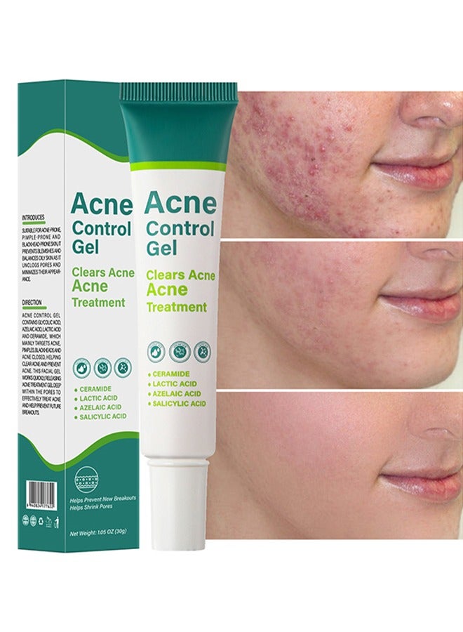 MOOYAM Acne Control Gel, Clears Acne, Acne Treatment Cream,Acne Spot Treatment gel,Clear Acne Spot Treatment Gel,Pimple Cream for Acne Prone Skin Care,Salicylic Acid Acne Treatment Gel,Clear Breakouts 30g  - Image 1