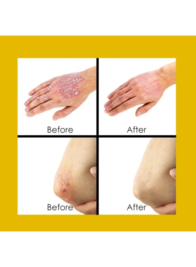 Sumifun Psoriasis Cream, Skin Repair Ointment for Psoriasis, Eczema, and Dermatitis Relieves Itching and Redness Moisturizing & Soothing Treatment for Hands, Feet, and Body, Hypoallergenic 20g - Image 5