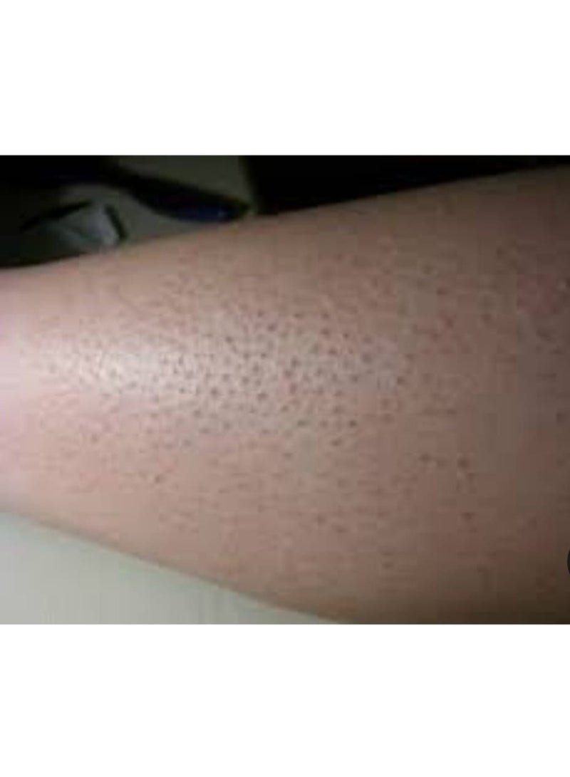 DIDA Say goodbye to keratosis pilaris (chicken skin)! Enjoy silky-smooth feet with Deda Cream! - Image 4