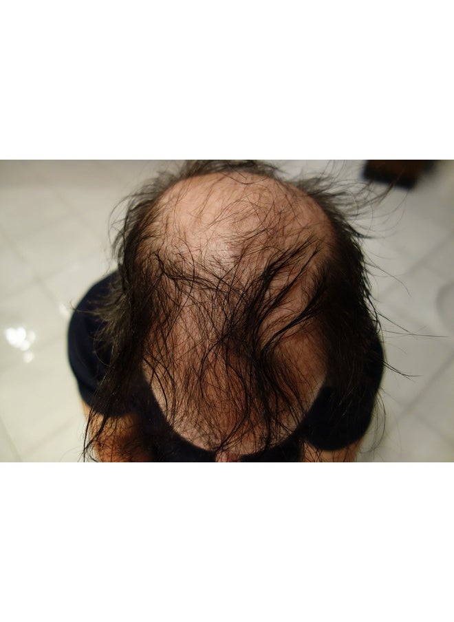 Finally Hair - Fibers Refill Bag 56 Grams Of Premium Hair Loss Concealer In A Refill Bag (Dark Brown W/Slight Reddish Hue) We Have 2 Dark Brown Shades See Pictures - Image 1