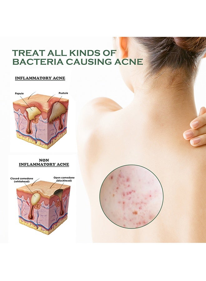 EELHOE Body Acne Removal Cleanser Spray, Back Acne Treatment, Back Acne Spray, Body Acne Marks Repair Back Shoulder Acne Skin Care Spray,120ml - Image 4