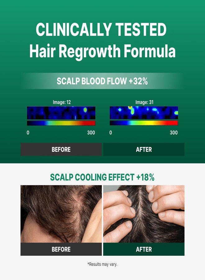 Fromforet Spicule Microneedling Exosome Hair Growth Serum, Hair Loss Treatments for Women and Men, Peppermint Oil Cooling Scalp Serum, Menthol, Korean Hair Care (0.5 fl oz / 15ml) - Image 3