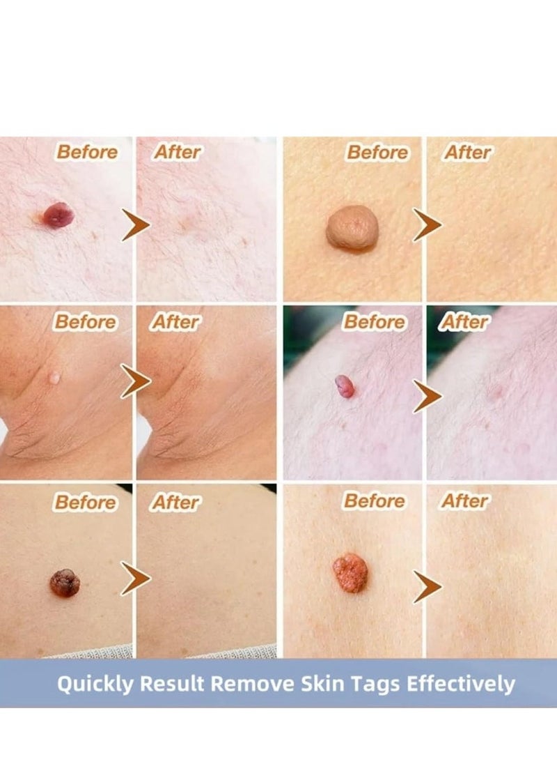 EELHOE 144 قطعة لاصقات إزالة الثآليل، لاصقات مزيل الثآليل الطبيعية، وسادات إزالة الشامات وعلامات الجلد، علاج خالي من الألم للثآليل لليدين والوجه والجسم - Image 3