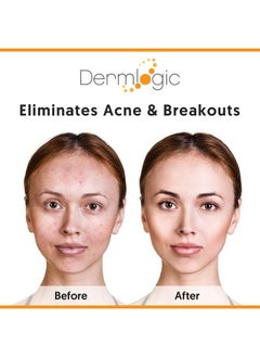 Dermlogic Acne Face & Body Cream Maximum Strength Treatment For Cystic Blackhead & Whitehead Pimples. Prevents Future Breakouts. Use On Face Body Chest & Back For Teens & Adults.  - Image 4