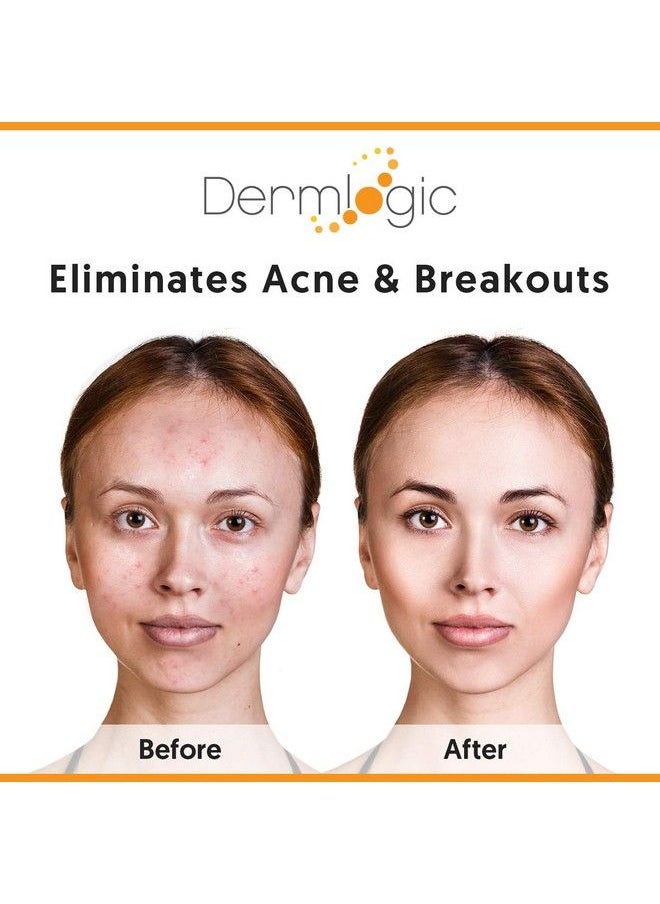 Dermlogic - كريم وجه وجسم لعلاج القوة القصوى لحب الشباب للبثور السوداء والبيضاء. يمنع ظهور الحبوب المستقبلية. يستخدم على الوجه والجسم والصدر والظهر للمراهقين والبالغين. - Image 1