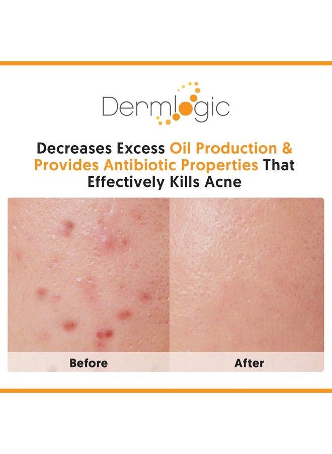 Dermlogic - كريم وجه وجسم لعلاج القوة القصوى لحب الشباب للبثور السوداء والبيضاء. يمنع ظهور الحبوب المستقبلية. يستخدم على الوجه والجسم والصدر والظهر للمراهقين والبالغين. - Image 1
