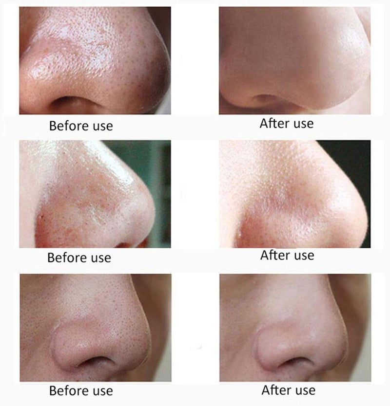 HETARMI ENTERPRISE Hetarmi Facial Pore Cleanser Blackhead Remover Suction Electric Machine multi color - Image 5