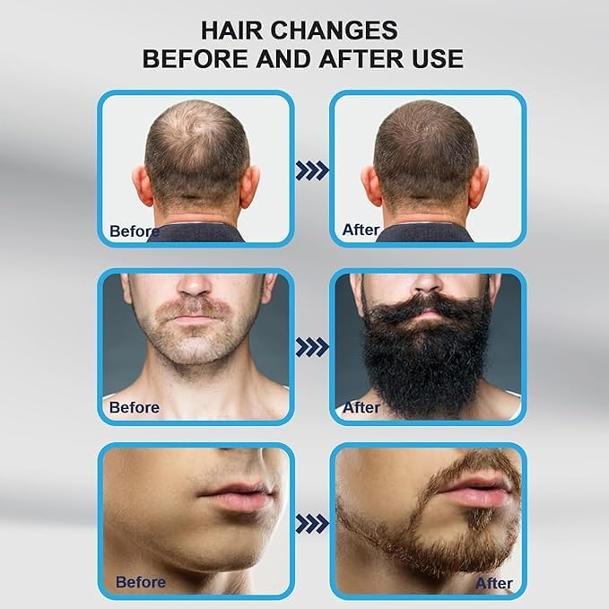 140 Titanium Adjustable Micro Needles Facial Derma Roller Kit for Skin Repair, Face, Hair & Beard Growth - Image 3