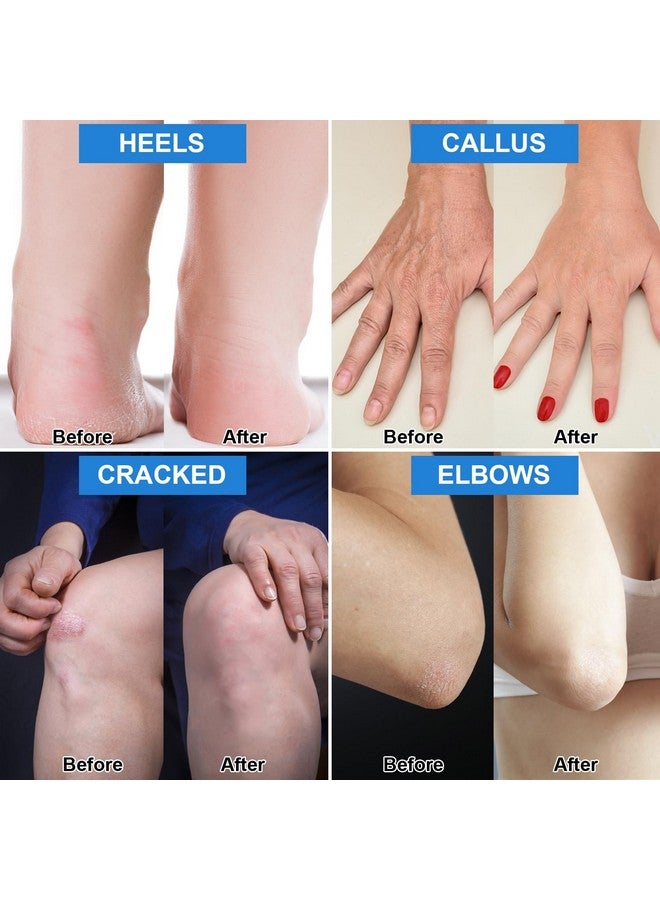 Charmonic 7.06 أونصة / عبوة من 2 كريم اليوريا 42% بالإضافة إلى حمض الساليسيليك 2% كريم اليوريا للقدم للعناية بالقدم وعلاج تشقق الكعب والركبتين والمرفقين وعلاج اليدين ومرطب القدمين ومسامير الذرة والجلد الميت وترطيب عميق - Image 5