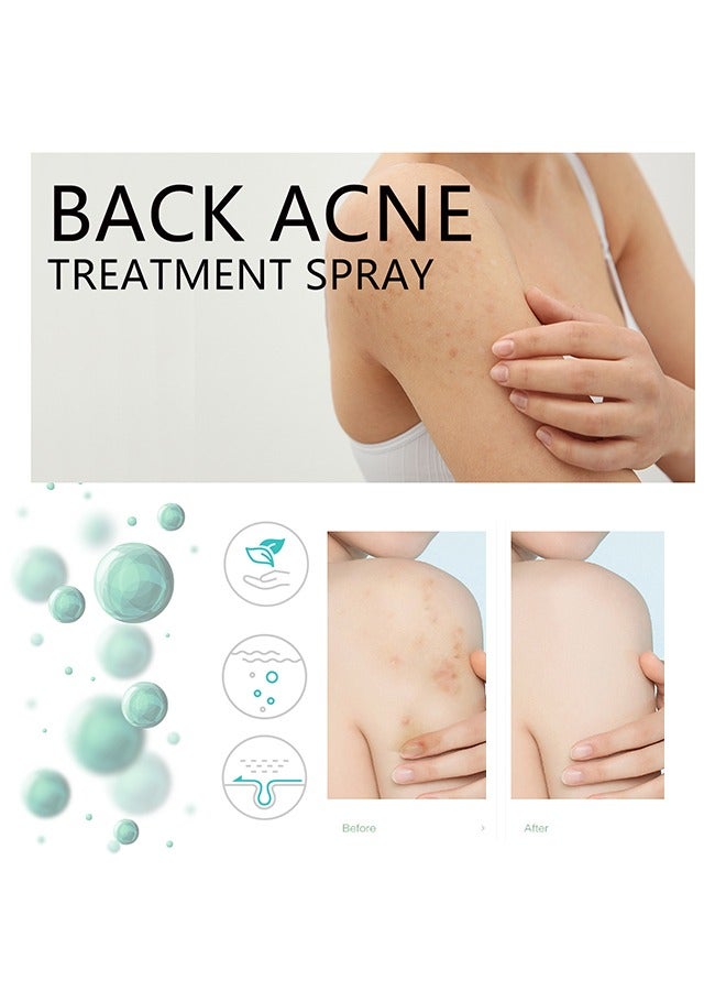 Jaysuing Soothing And Cleansing Keratosis Pilaris and Acne Repair Body Refreshing Cream -Removes Dead Skin,Promotes Acne Removal and Helps Restore The Skin Protective Barrier 48g - Image 4