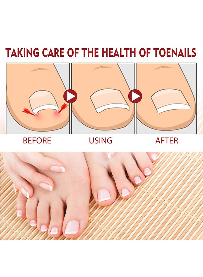 Jaysuing Toenailcare Removal Paronychia Oil - Bunion Therapy Oil - Toenailcare Anti Paronychia Relief Oil Repair For Damaged Discolored Thick Nails 10ML - Image 5