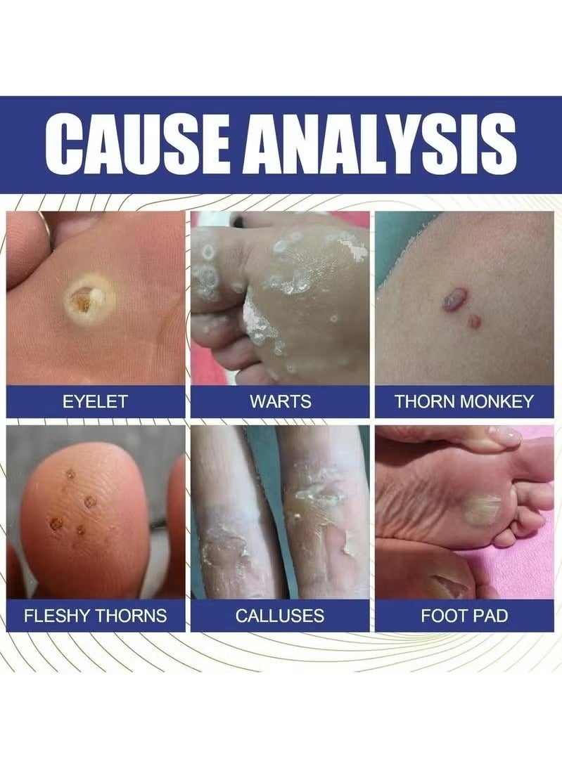 Lanthome Wart Remover, Fast Acting and Painless Skin Tag Remover Liquid, Tags and Mole Remover, Tag-Remover for Hands and Body, Wart Cream for Genital Warts, Plantar Wart, Common Wart, Corn, Flat Wart - Image 4