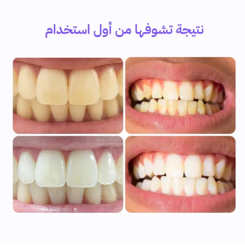 سي سمايل لصقات تبييض الاسنان الأرجوانية 14 لصقة من سي سمايل - Image 4