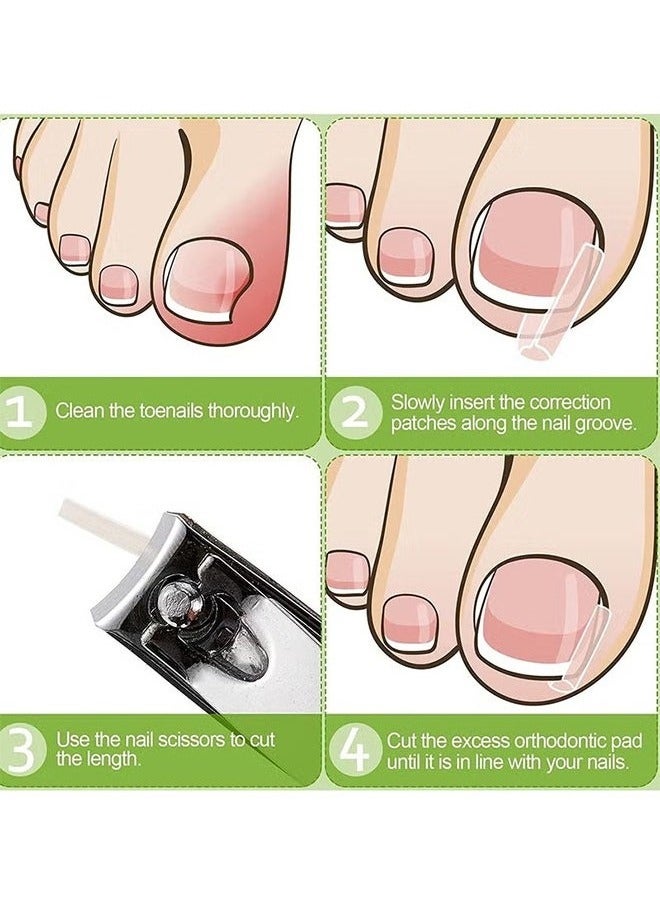 Generic Ingrown Toenail Corrector Strips Toenail Correction Patches Curved Toenails Straightening Recover Clips Thick Paronychia Pedicure Tool Toenail Straightener Strip for Men Women Foot Care 100 Pieces  - Image 4