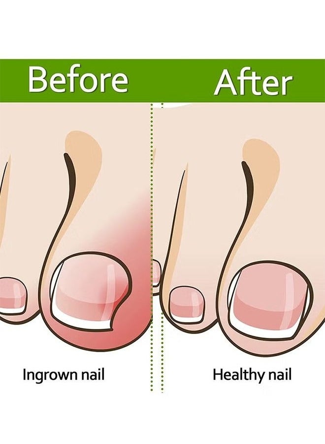 Generic Ingrown Toenail Corrector Strips Toenail Correction Patches Curved Toenails Straightening Recover Clips Thick Paronychia Pedicure Tool Toenail Straightener Strip for Men Women Foot Care 100 Pieces  - Image 3