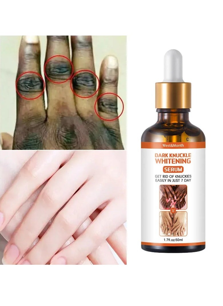 West&Month - Acanthosis Nigricans Therapy Oil, 50ml Strong Dark Knuckle Whitening Serum, Skin Brightening Dark Knuckles Remover Oil , Knuckle Whitening Cream Corrector For Knuckle Finger Elbow And Knee - Image 1