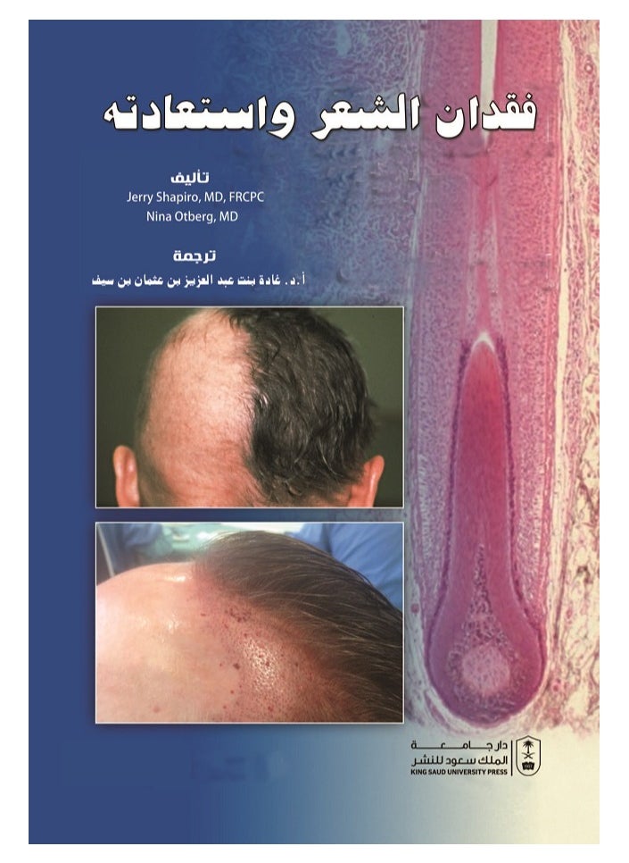Hair loss and restoration 