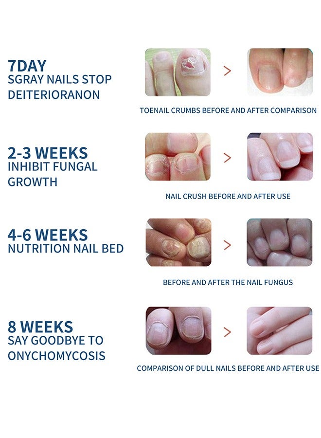 إيلهو علاج أظافر القدم، 32 قطعة من لاصقات إصلاح الأظافر، علاج لإصلاح الأظافر التالفة وظهور تغير لونها - Image 4