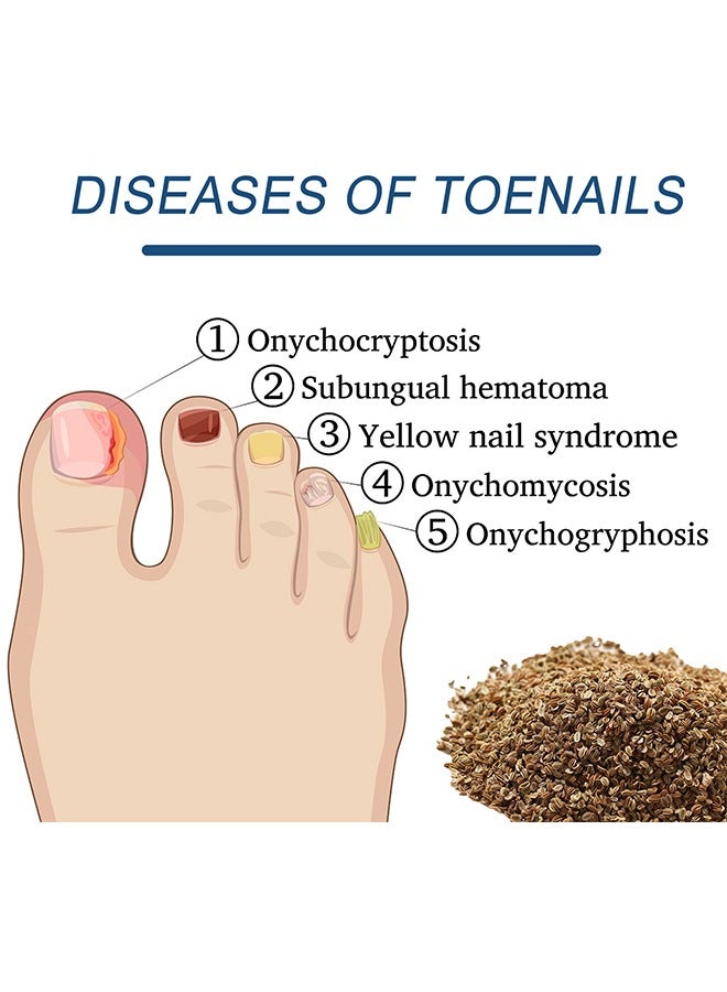 إيلهو علاج أظافر القدم، 32 قطعة من لاصقات إصلاح الأظافر، علاج لإصلاح الأظافر التالفة وظهور تغير لونها - Image 5