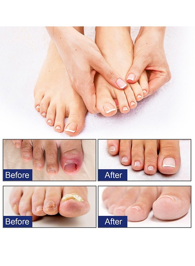 Ingrown Toenail Drops, Nail Care Essential Oil Cleans And Removes Gray Nails, Toe Nail Repair Treatment Extra Strength For Thick Nails Cracked Damaged Discolored