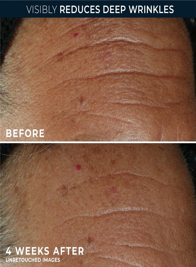 RoC سيروم روك ديرم كوركسيون فيل + تريت المتقدم مع الريتينول، علاج ملء التجاعيد مع حمض الهيالورونيك لخطوط العين، 11 تجاعيد، وخطوط الضحك، (0.5 أونصة سائلة) مع عبوة ريتينول (قد يختلف التغليف)  - Image 5