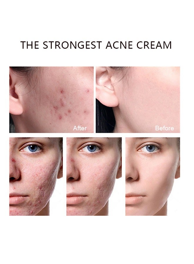 Jaysuing Blemish Cream, Facial Oil Control Acne Cream, for Fast Acne Removal for Oily and Acne-prone Skin, Non-Irritant, Women 30g - Image 4
