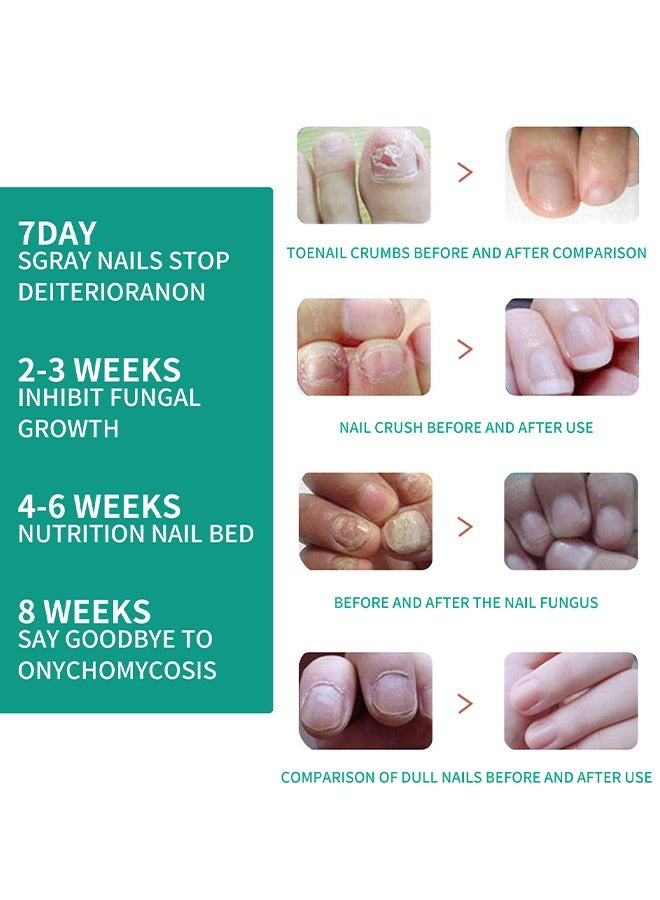 SOUTH MOON Nail Fungus Ointmen - Thickening, Brightening, and Repairing Solution for Damaged Nails on Hands and Feet - Image 2