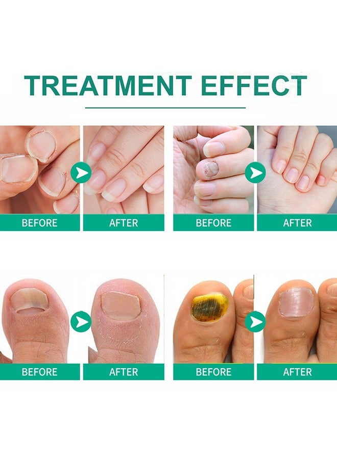 SOUTH MOON Nail Fungus Ointmen - Thickening, Brightening, and Repairing Solution for Damaged Nails on Hands and Feet - Image 5