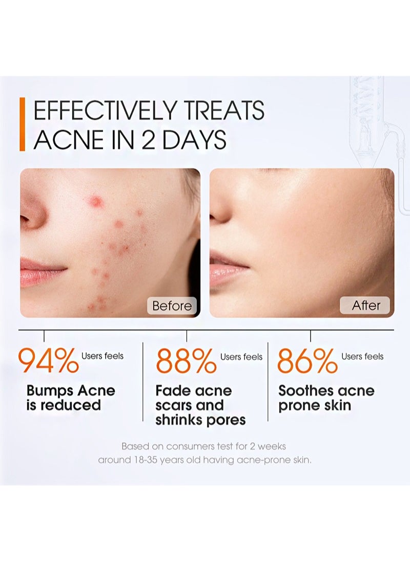 SKIN EVER - Salicylic Acid Anti Acne Serum，Contains Salicylic Acid, Niacinamide, Centella Asiatica Extract, And Ceramide To Clear Acne, Fade Acne Marks, And Repair Damaged Skin (20ml) - Image 1