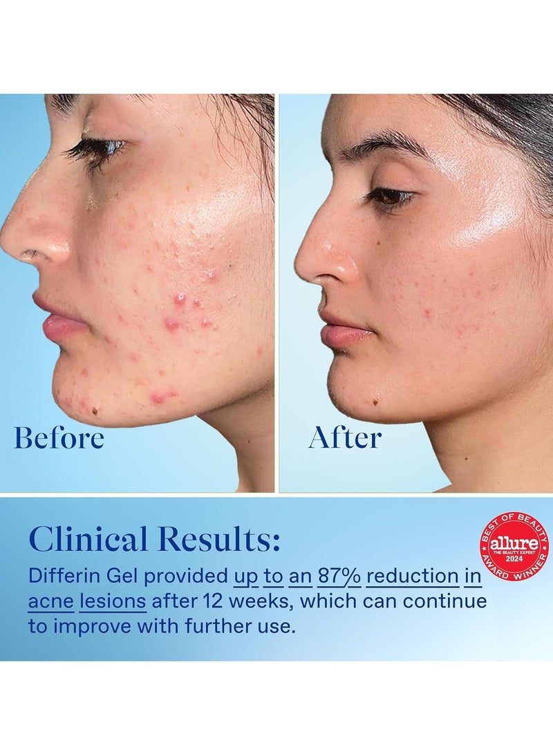 Differin Acne Treatment Gel, 90 Day Supply, Retinoid Treatment for Face with 0.1% Adapalene, Gentle Skin Care for Acne Prone Sensitive Skin, 45g Pump (Packaging May Vary)