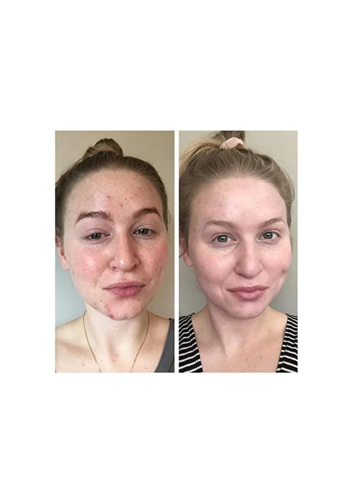 Stridex Essential Single-Step Acne Control Pads - Alcohol Free, 55 Soft Touch Pads with Vitamins - Image 4